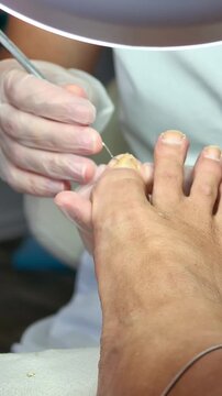 A podiatrist treats an ingrown toenail using a special instrument.