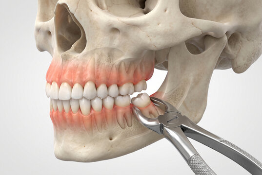 Wisdom Tooth Removal Surgery Showing Inflamed Gums and Extraction Forceps, 3D Rendering