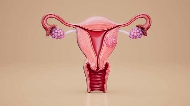 Conceptual 3D animation of a uterine fibroid and uterine anatomy