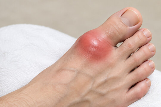 Swollen big toe joint on white cushion, gout and inflammation concept