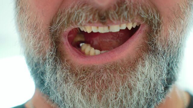 Problematic teeth with visible yellowing, plaque and tartar buildup in bearded man mouth. Close up male dental condition with stained enamel and calculus. Oral health problems, poor dental hygiene and