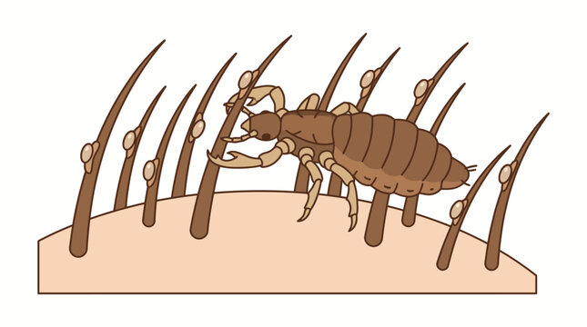 Head Louse And Nits On Hair Strands Scalp Infestation Illustration