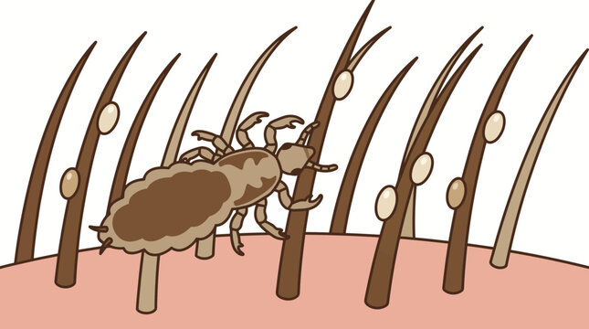 Head Louse Infestation With Nits Attached To Hair Strands Illustration