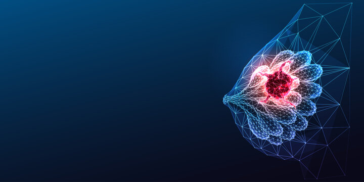 Glowing neon polygonal breast anatomy reveals a tumor symbolizing breast cancer.