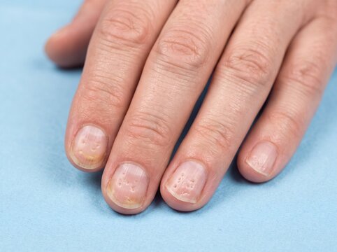 Nail Psoriasis with Nail Pitting and Separation