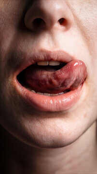 Tongue showing abnormal growth and texture. Medical concept for oral cancer or glossitis diagnosis.