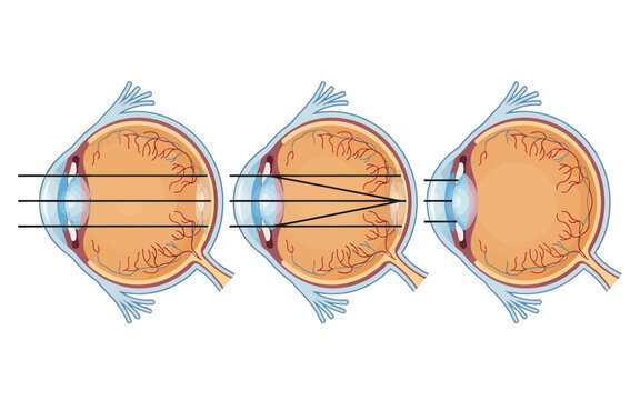 Illustration showing different types of vision focusing in human eyes