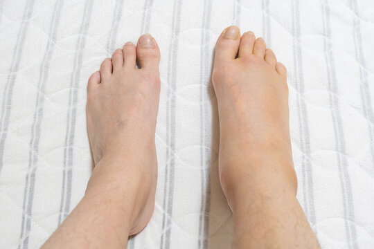 アキレス腱手術後の右足のむくみ・左右の足を比較