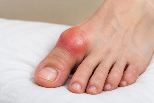 Swollen big toe joint on white cushion, gout and inflammation concept