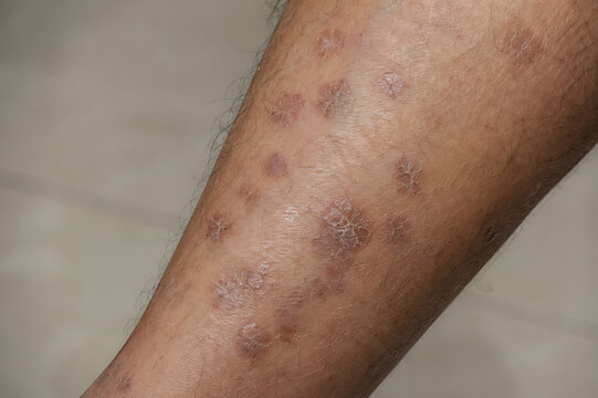 Multiple Dark Skin Marks and Healed Lesions on Leg Close Up Showing Hyperpigmentation, Scarring and Dermatological Skin Changes