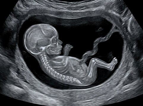 Ultra realistic medical prenatal ultrasound image of a healthy human fetus at approximately 20 weeks of pregnancy inside the uterus clear fetal side profile visible skull facial features developing sp