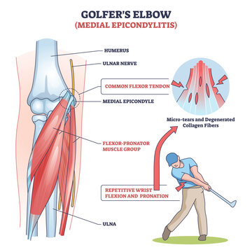 Golfers elbow medial epicondylitis shown as a brief anatomy diagram of elbow bones, common flexor tendon, and flexor-pronator muscles, linking swing overuse to micro-tears. Outline diagram