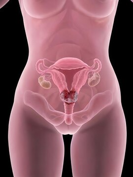Cervical Cancer 3D medical illustration showing malignant tumor lesion in human cervix anatomy