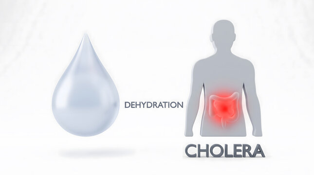 Medical illustration depicting cholera disease and severe dehydration symptoms