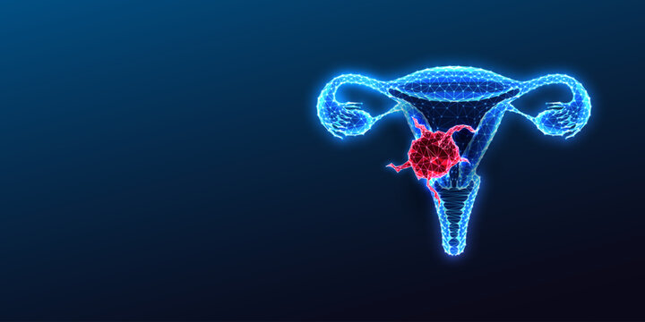 Glowing neon polygonal uterus shows a malignant tumor representing cervical cancer. 