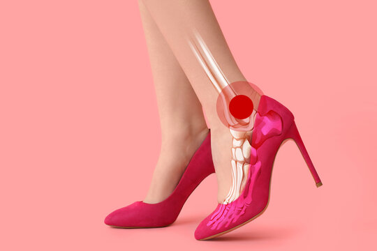 Foot pain and high heels, ankle injury and orthopedic health issues caused by uncomfortable footwear, woman wearing pink stilettos with medical anatomy