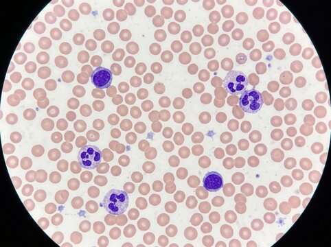 Microscopic View Of Blood Cells Showing Erythrocytes And White Blood Cells