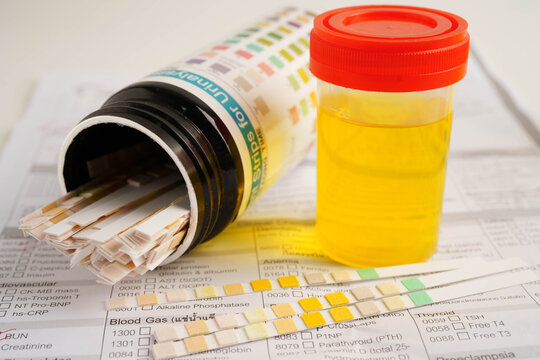 Urinalysis, urine cup for check health examination in laboratory.