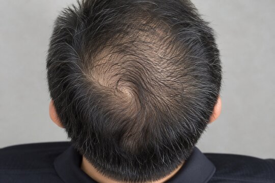 Thinning hair at the crown of an Asian man seen from above