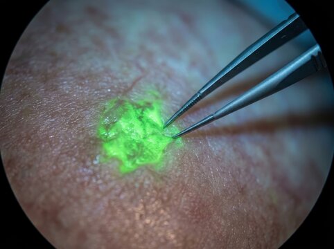 Surgical tweezers extracting fluorescent biomarker for advanced biotechnology research and clinical precision diagnostics and future medicine.