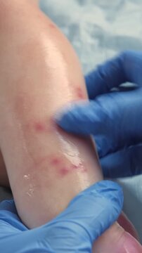 Doctor hands examining infant leg. Little Kid allergy. Closeup. Child scratches a red rash. Nurse applies a special cream to atopic skin. Dermatitis, diathesis, irritation on the baby body. Pruritus