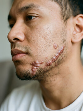 Close up portrait of a young man with a visible keloid scar on his jawline and cheek