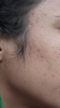 Close up of skin texture showing acne breakout, blemishes, and post-acne marks on a cheek