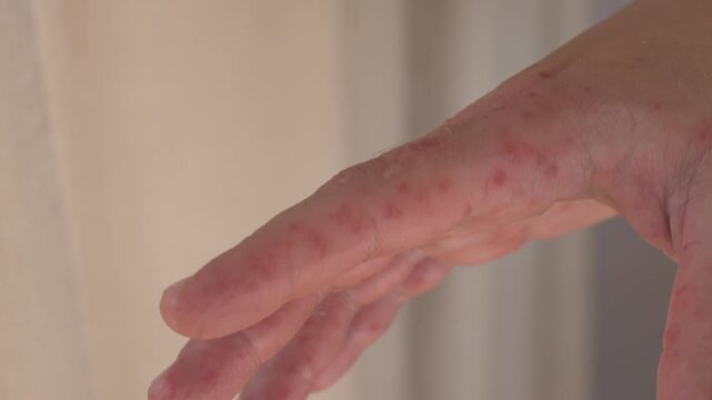 Rash on hand remains visible as fingers shift position. Eczema and dermatitis signs include scattered red spots on skin, creating worried medical view for allergy or Coxsackie virus review.