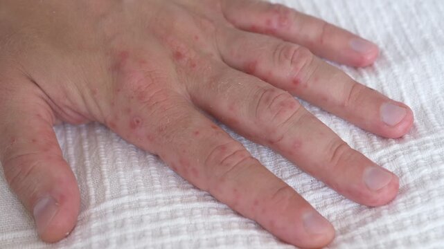 Hand rash remains visible on skin. Inflamed knuckles and scattered red bumps suggest eczema, dermatitis, allergy, or coxsackie virus symptoms, with worried medical focus on affected hand.