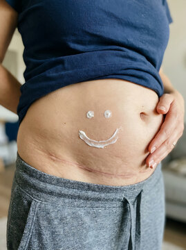 Woman with a cesarean section scar on her abdomen showing a smiley face drawn with skin cream