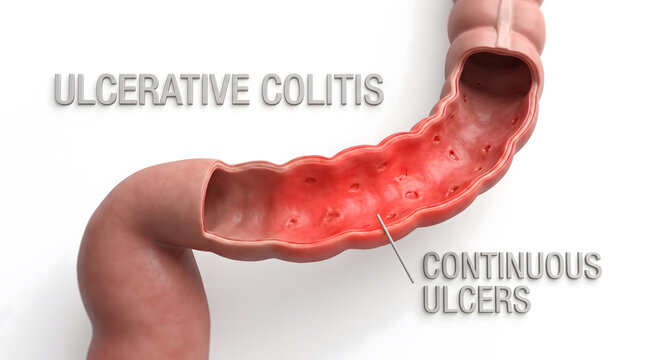 Medical illustration of ulcerative colitis showing continuous ulcers in the colon