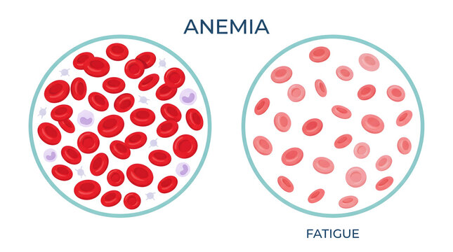 Medical comparison showing healthy blood cells versus anemic cells causing fatigue