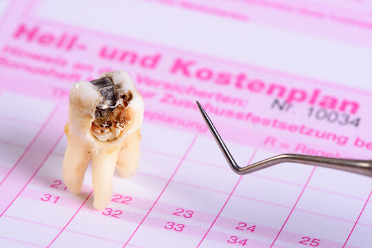 Auf einem Heil- und Kostenplan liegt ein extrahierter Backenzahn mit Karies und Amalgamf&uuml;llung