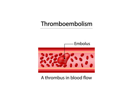 Thromboembolism. Circulating blood clot. Normal blood flow and a thrombus in blood flow, embolus. Red blood cell. Vector illustration.