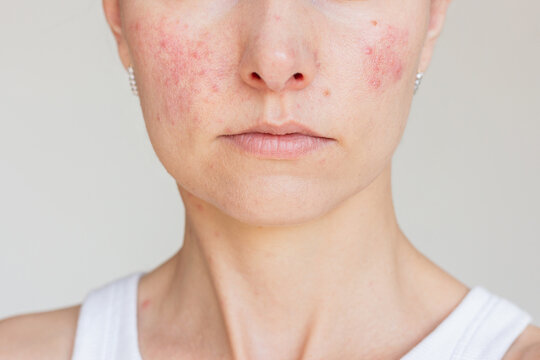 Close-up portrait of a young Caucasian woman suffering from the skin chronic disease rosacea on her face in the acute stage. Dermatological problems.