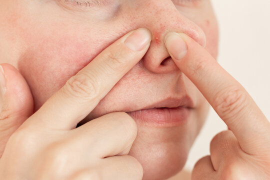 Close up of a young woman squeezing a pimple on her nose with fingers. Unsafe acne popping concept.