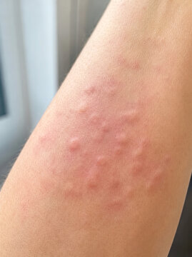 Red Bumpy Rash on Human Skin Showing Signs of Allergic Reaction and Hives, Medical Condition for Health Care Documentation