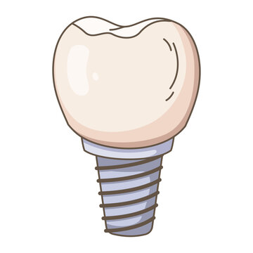 Dental implant molar tooth vector illustration