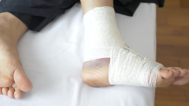 A close up view of an injured foot wrapped in a white bandage with metal clips, indicating recovery after an accident or injury in a medical setting
