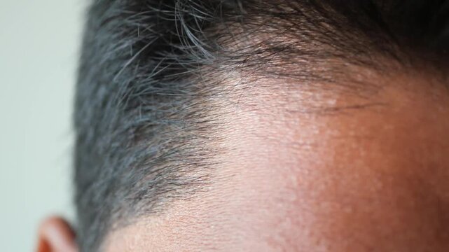 Close-up of man's receding hairline as he touches his hair