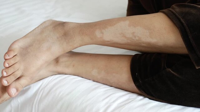 Woman showing vitiligo patches on her legs while sitting on bed indoors