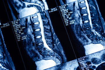 Obraz premium High resolution cervical spine mri sagittal scan for medical diagnosis reference and clinical study background