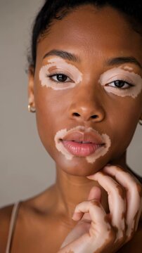 Portrait of a young Black woman with vitiligo, skin diversity and self acceptance