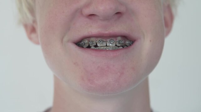 Close-up of a smiling teenager wearing dental braces. Orthodontic treatment with metal brackets on teeth, dental care and healthy smile concept