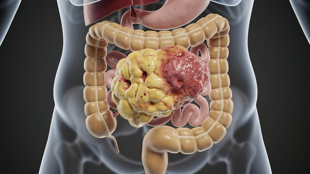3D anatomical illustration showing omental sarcoma tumor inside human abdominal cavity, transparent torso with digestive organs