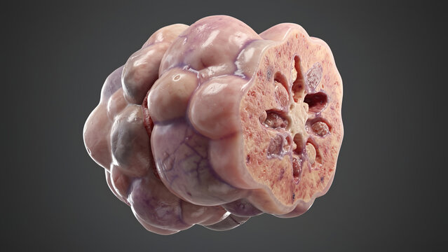 3D anatomical illustration of polycystic kidney, cross-section showing cysts and damaged renal parenchyma