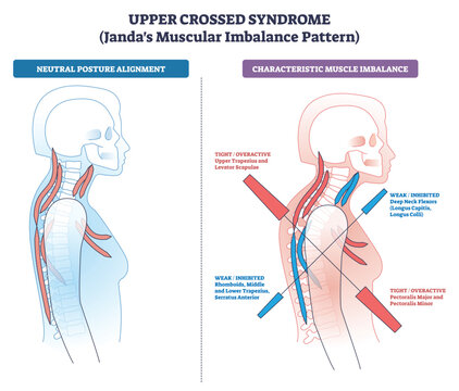 Upper Crossed Syndrome Janda pattern shows head-forward posture and opposing tight-weak muscles, key objects, neck spine, chest-shoulder muscles, crossed arrows indicating imbalance. Diagram