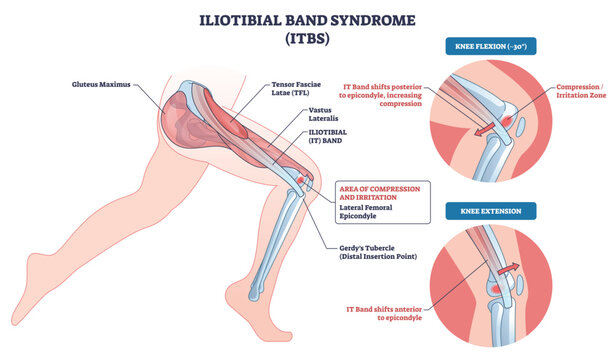 Iliotibial band syndrome pathomechanics shown on a runners leg, highlighting IT band, lateral femoral epicondyle, and knee joint compression during flexion and extension. Outline diagram