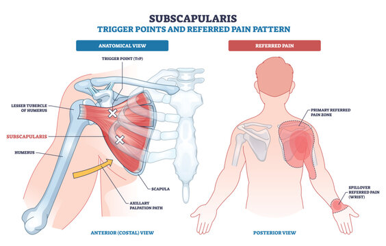 Subscapularis trigger points and referred pain mapped, highlighting subscapularis muscle, scapula, and shoulder pain zones with wrist spillover for quick clinical reference. Outline diagram