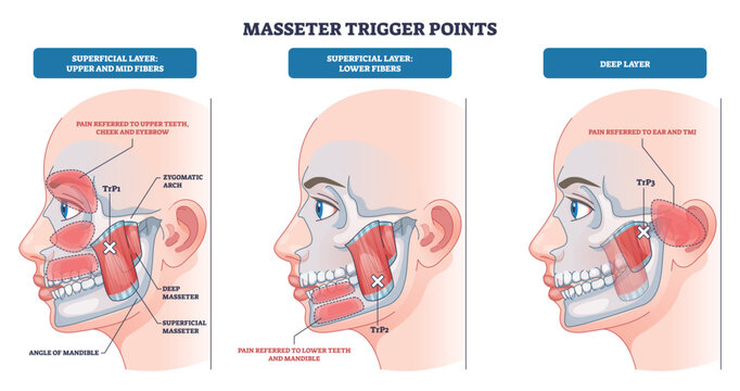 Masseter trigger points and referred pain mapped on jaw muscles, illustrating facial zones and TMJ referral, key objects, masseter muscle, mandible, ear. Outline diagram